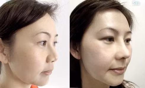 Trước và sau khi phẫu thuật nâng mũi.