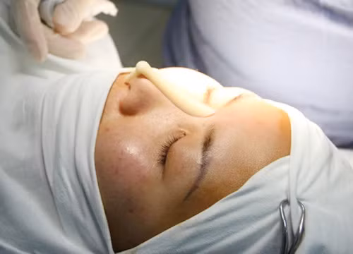 Bước 2: Sau khi quyết định, bạn sẽ được đưa vào phòng tiểu phẫu. Tại đây, bác sĩ tiến hành gây tê để chuẩn bị cho cuộc phẫu thuật nâng mũi của bạn.