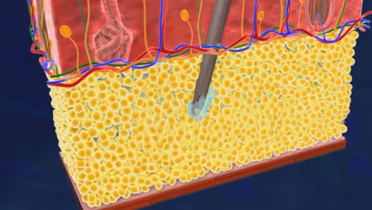 Bước 2: Bác sĩ sử dụng Laser để tác động trực tiếp vào vùng mỡ điều trị, nhiệt lượng từ Laser tác động trực tiếp vào các tế bào mỡ, hóa lỏng hoàn toàn các mô mỡ