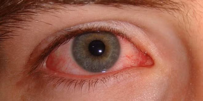 Đau mắt đỏ do virus đang ở thời điểm bắt đầu mùa dịch, dự báo bệnh sẽ còn diễn biến phức tạp trong thời gian tới. Tuy nhiên, các bác sĩ chuyên khoa mắt cũng khẳng định việc phòng bệnh đau mắt đỏ không hề khó khăn.