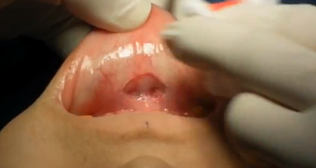 Phương pháp thứ hai: Rạch từ trong. Bác sĩ sẽ rạch và đưa miếng silicon từ bên trong miệng bạn, cụ thể là ở nướu dưới.