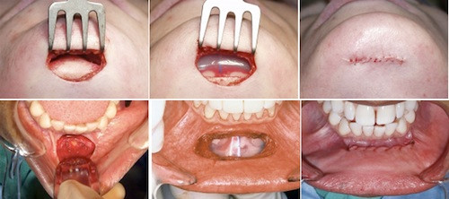 Cách này không để lại sẹo lộ bên ngoài, tuy nhiên lại dễ nhiễm trùng và đòi hỏi bạn cần chăm sóc răng miệng kỹ lưỡng sau khi phẫu thuật.