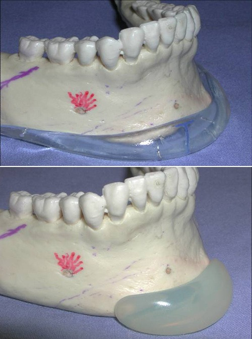 Có hai loại phẫu thuật độn cằm phổ biến nhất. Phương pháp thứ nhất là rạch từ ngoài: Với phương pháp này, bác sĩ phẫu thuật sẽ rạch một đường phía ngoài da rồi nhét miếng silicon vào bên trong. Cách này đơn giản hơn nhưng có thể để lại sẹo ẩn lâu dài.