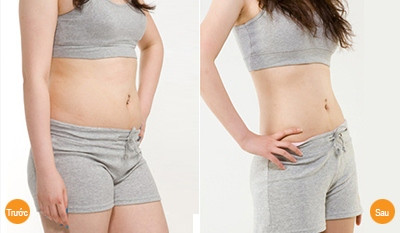 Hình ảnh bụng được cải thiện rõ ràng so với trước khi hút mỡ, thon gọn hơn khiến người phụ nữ trở nên hấp dẫn hơn.