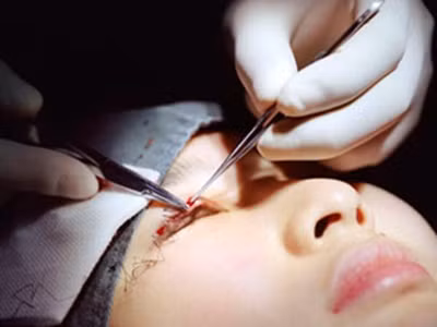 Tiếp đó, bác sĩ sẽ lựa chọn, hoặc rạch một đường rất nhỏ trên da mi mắt rồi luồn chỉ vào, khâu liên tục tạo thành hai mí mắt, hoặc đưa chỉ vào bên trong mi mắt và khâu rời.