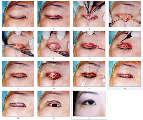 Các bước cắt mí mắt.