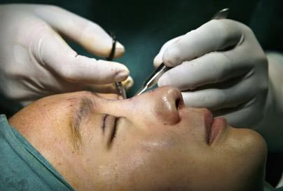 Đầu tiên, các bác sĩ sẽ đo và vẽ viền mi mắt cho bạn rồi dùng dao, kéo rạch liên tục theo đường viền vừa vẽ.