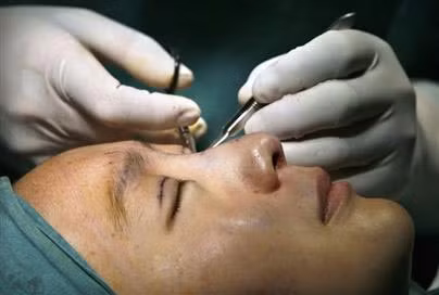 Đầu tiên, các bác sĩ sẽ đo và vẽ viền mi mắt cho bạn rồi dùng dao, kéo rạch liên tục theo đường viền vừa vẽ.