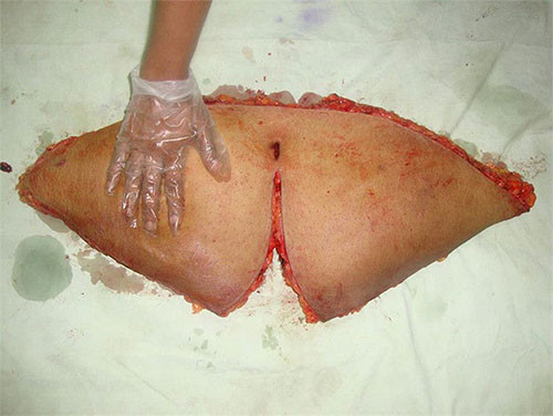 Đây là một phần da bụng cùng mô mỡ thừa được loại bỏ.