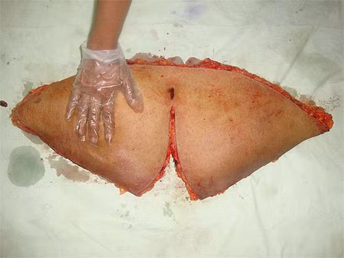 Đây là một phần da bụng cùng mô mỡ thừa được loại bỏ.