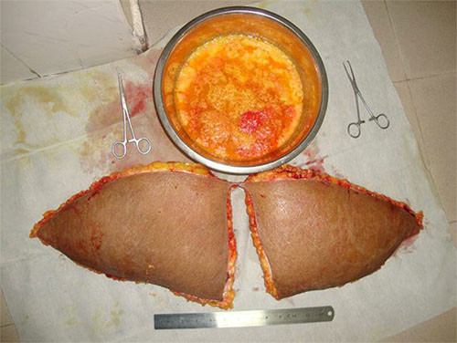 Phần da thừa, mô mỡ và mỡ hóa lỏng được hút ra khỏi người bị loại bỏ.