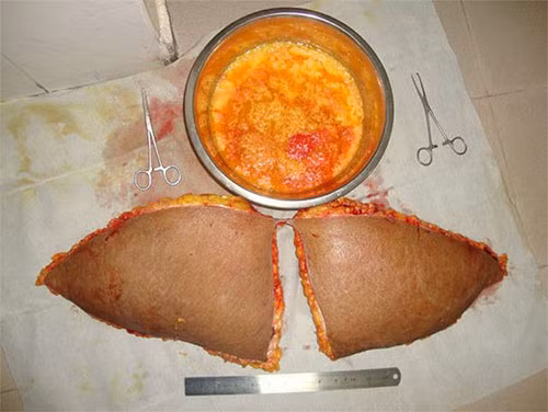 Phần da thừa, mô mỡ và mỡ hóa lỏng được hút ra khỏi người bị loại bỏ.