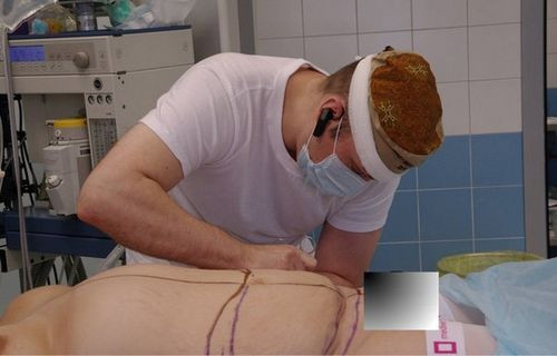 Bước 3: Thông thường, trước khi phẫu thuật, hoặc hút nội soi, bác sĩ phải vẽ để định hình phần da phải cắt bỏ, phần mỡ cần hút.