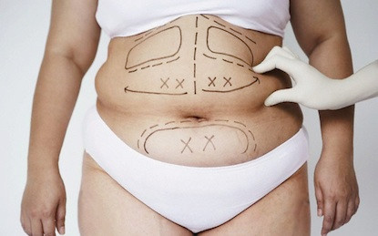 Hút mỡ thông thường trải qua 8 bước cơ bản. Bước 1: Trước khi làm phẫu thuật, bệnh nhân phải nhịn ăn và xét nghiệm toàn thân. Chỉ khi nào các chỉ số xét nghiệm đạt tiêu chuẩn, bệnh nhân mới được phép tiến hành phẫu thuật.