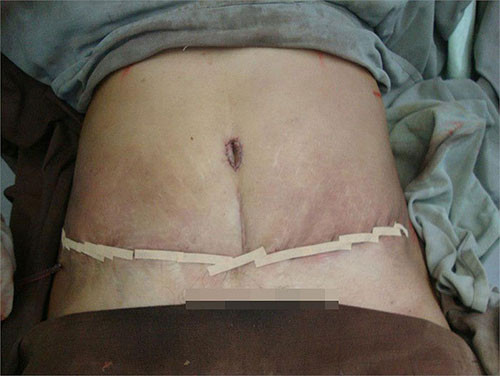 Sau khu hút mỡ, người bệnh sẽ bị đau ở vùng mổ vài ngày, bụng sưng, phù nề từ 1-2 tuần.