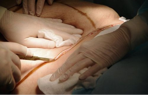 Sau đó, dựa vào đường vẽ, bác sĩ sẽ rạch những nhát rất ngọt trên bụng.