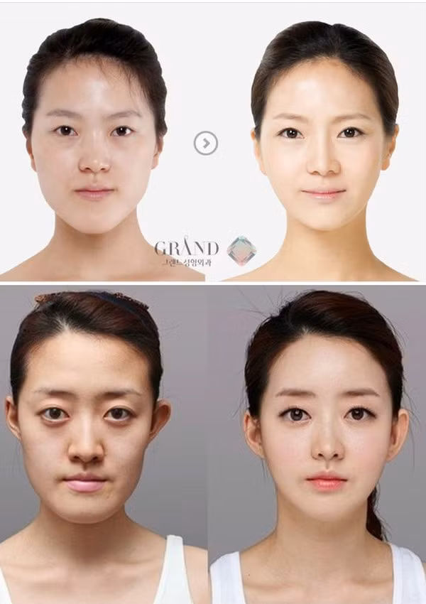 Các hình thức phẫu thuật thẩm mỹ mà người dân Hàn Quốc ưa chuộng là cắt mí, gọt hàm để khuôn mặt trở nên thon gọn hơn.