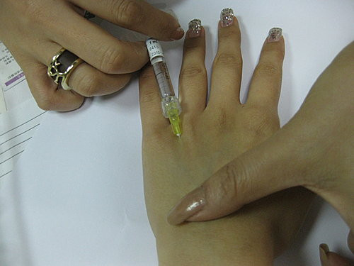 Tiêm chất làm đầy để bàn tay được tròn trĩnh, búp măng.