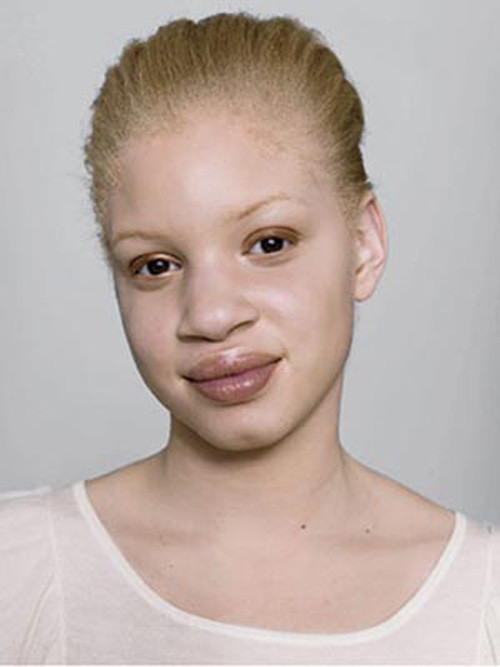 Theo cảnh báo của bác sĩ và nhà nghiên cứu Lester Davids ở Đại học Cape Town. Những nguy hiểm do sử dụng một số loại kem tẩy trắng da không đảm bảo chất lượng bao gồm: ung thư máu như là bạch cầu, ung thư gan và thận cũng như các bệnh về da nghiêm trọng.