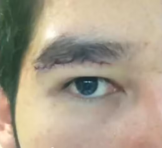 Phẫu thuật nâng cơ mắt.