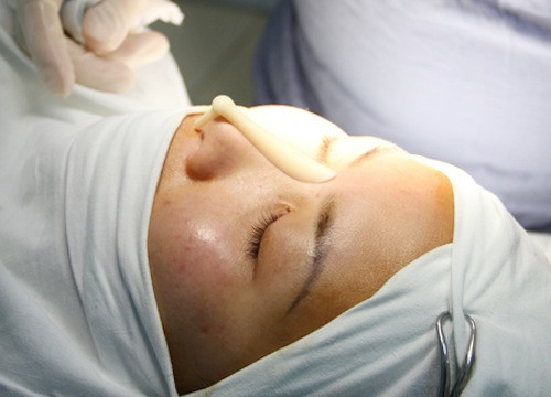 Bước 2: Sau khi quyết định, bạn sẽ được đưa vào phòng tiểu phẫu. Tại đây, bác sĩ tiến hành gây tê để chuẩn bị cho cuộc tiểu phẫu của bạn.