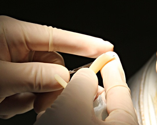 Bước 3: Bác sĩ sẽ lựa chọn và thử trên mũi bạn những miếng sụn nhân tạo khác nhau sau đó quyết định xem liệu nó đã hợp với bạn chưa? Sau khi đã ưng ý, bác sĩ sẽ cắt gọt lại miếng sụn sao cho phù hợp với dáng mũi lúc đầu của bạn cũng như tổng thể gương mặt.