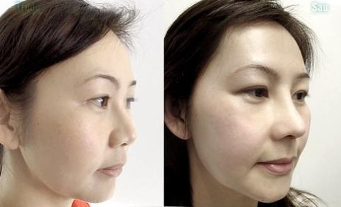 Trước và sau khi phẫu thuật nâng mũi.
