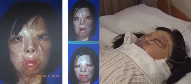 Đám cháy kinh hoàng năm cô 5 tuổi đã phá hủy gần như hoàn toàn khuôn mặt của Xu Jianmei.