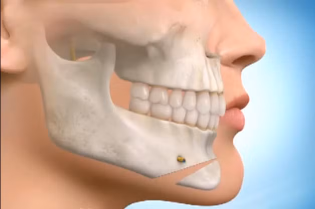 Sau đó, kéo phần xương cằm khít vào xương toàn mặt...