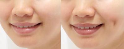 Tuy nhiên, má lúm đồng tiền "nhân tạo" sẽ hiện diện ngay cả lúc không cười và có thể tiêu tan sau một vài năm.