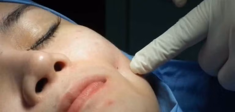 Một mũi khâu nhỏ sẽ được xuyên qua mặt trong má và đính cơ vào mặt dưới da tạo má lúm tại vị trí đã được bác sĩ đánh dấu.