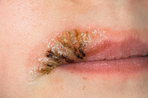 Các loại miếng dán xăm môi, đặc biệt là miếng dán có phát sáng thường được sản xuất bằng mực đặc biệt UV (mực tử ngoại), có chứa chất hyaluronie axít nên rất dễ làm cho vùng da tiếp xúc bị tổn thương và gây dị ứng đỏ da, sưng phù, chảy nước, mụn mủ…