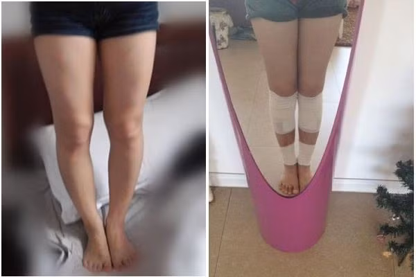 Hình ảnh đôi chân trước và sau khi phẫu thuật kéo dài chân.