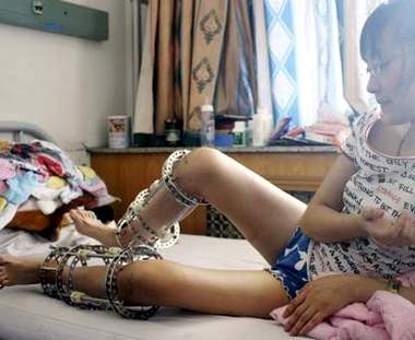 Trung bình để kéo dài xương chân 5-7cm, bệnh nhân phải mang khung cố định 10-12 tháng, sau khi bỏ khung, bệnh nhân lao động, sinh hoạt hoàn toàn bình thường, các phần xương chân được kéo dài thêm có độ cứng chắc như xương cũ.