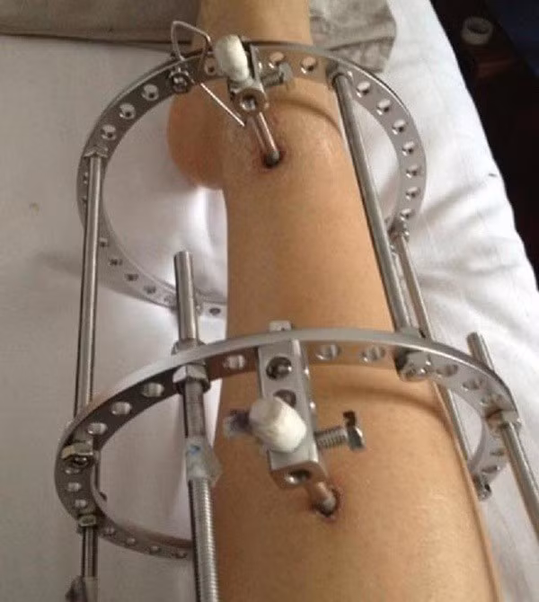 Nguyên lý của phương pháp kéo dài xương chân là cắt rời một chỗ trên đoạn xương chân cần kéo dài, xuyên các đinh chuyên dụng qua cả hai đoạn xương rời ra, rồi gắn vào một loại khung cố định đặc biệt ở bên ngoài chân.