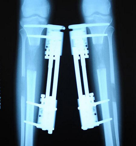 Hình ảnh chụp X-quang của một cô gái kéo dài xương chân.