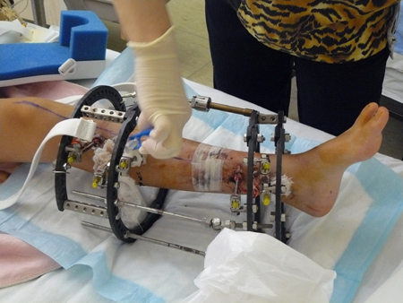 Đợi đến khi xương mới liền, người ta lại chỉnh vít trên khung bên ngoài, cho giãn ra khoảng 1mm/ngày ( kéo dài 2mm/ngày thì xương không kịp phát triển hoặc phát triển sẽ gây vẹo, méo, nếu chỉ kéo 0,5mm sẽ gây liền dính) nhằm mục đích bắt buộc các tổ chức xương phải tiếp tục lan ra để nối liền với nhau. Và cứ như vậy.... cho tới khi đạt được chiều dài xương chân như dự tính.