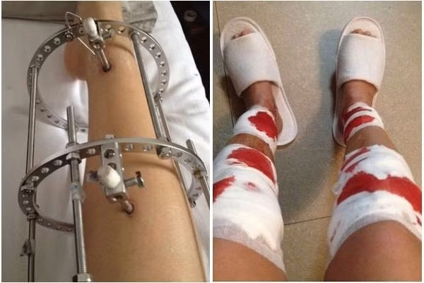 Sau nhiều tháng, đôi chân của cô gái sẽ dài ra. Tuy nhiên, mức độ đau đớn cũng như những biến chứng sau phẫu thuật sẽ đeo đuổi cô gái này suốt cả cuộc đời.