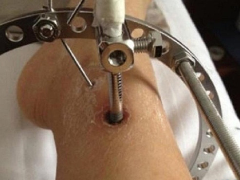 Sau khi cố định xương, cô gái phải nằm bất động 35 - 40 ngày. Đến khi tháo khung, chân vẫn luôn ở trong tình trạng rỉ máu.