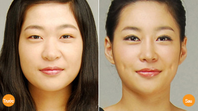 Hình ảnh trước và sau khi tạo má lúm đồng tiền.