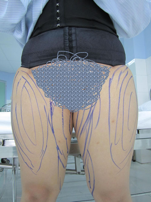 Bước 1. Các bác sĩ sẽ đánh dấu vùng da đùi cần hút mỡ, thường là vùng trên ngoài và trong đùi, đôi khi cả mặt trước và mặt sau đùi.