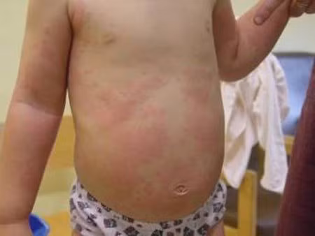 Trẻ bị dị ứng