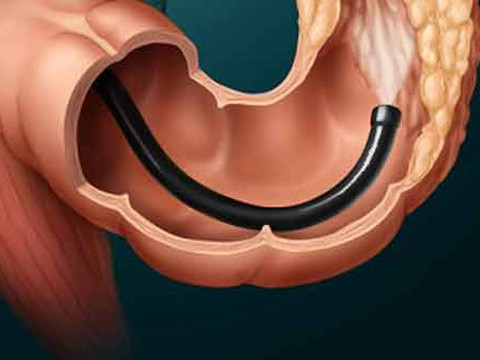 Nội soi giúp bác sĩ có thể dễ dàng phát hiện các khối u bất thường. Ảnh minh họa.