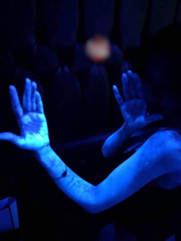 Đi pub cùng với hội bạn, tay chân cô gái bỗng phát sáng như zoombie - Hình 4 Di pub cung voi hoi ban, tay chan co gai bong phat sang nhu zoombie-Hinh-4