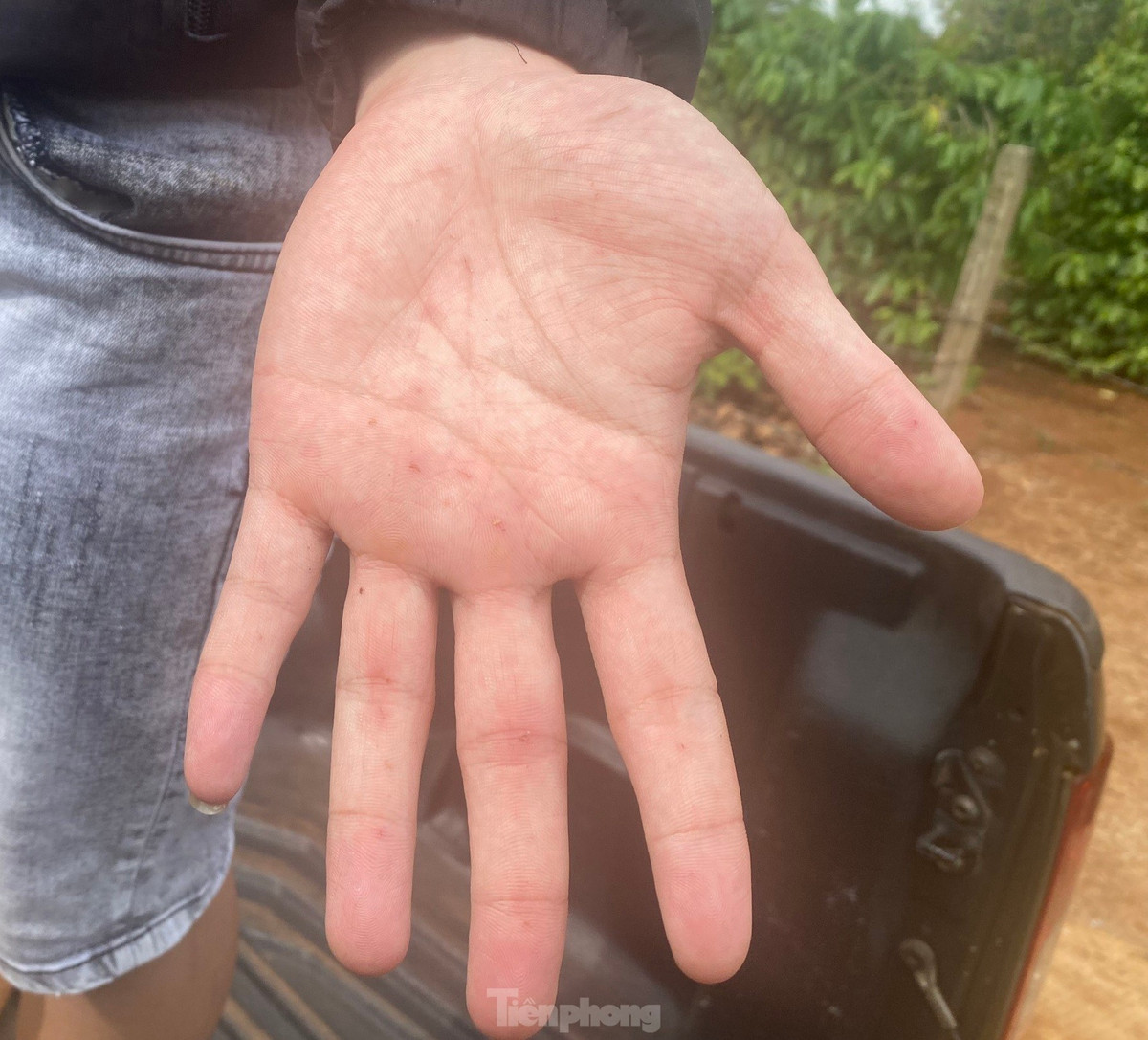 Bàn tay của Minh bị gai sầu riêng đâm xuyên 3 lớp bao tay vải.