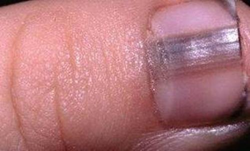 Tay xuat hien dau hieu nay, kham than ngay keo hoi khong kip-Hinh-2