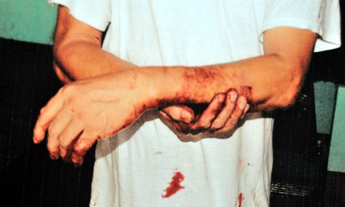 Ông Nam bị khâu 6 mũi ở tay.