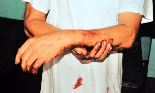 Ông Nam bị khâu 6 mũi ở tay.