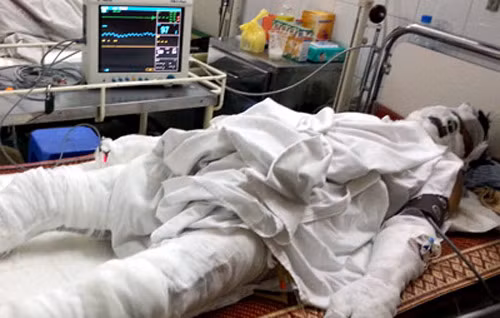 Anh Doãn Văn Hùng (43 tuổi cũng ở Phúc Thọ, Hà Nội) phải băng kín người.