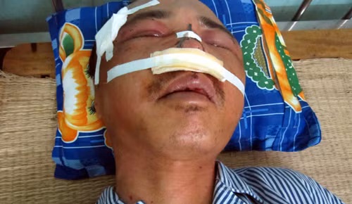 Anh Xuân bị nhóm côn đồ đánh